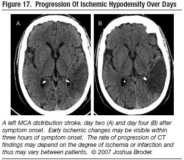 computed-tomography-ct-for-stroke